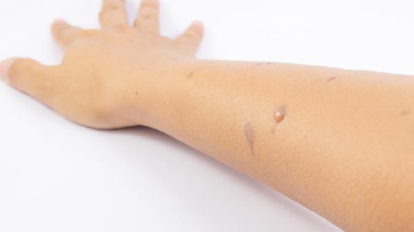 肺部出现水泡破裂会有风险吗