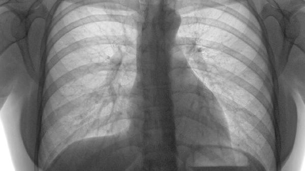 肺栓塞有哪些治疗方法可以选