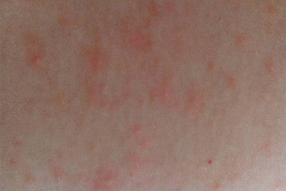 嗓子过敏引起的咳嗽有哪些症状