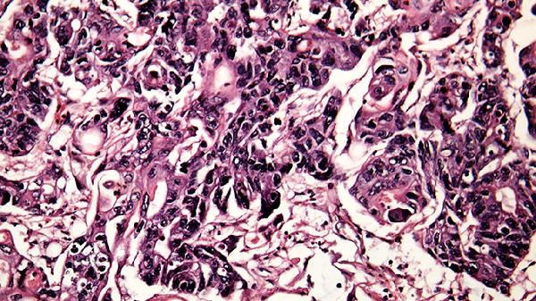 成人感染鼻病毒腺病毒会传播给别人吗