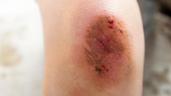 慢性肺脓肿常见表现有哪些