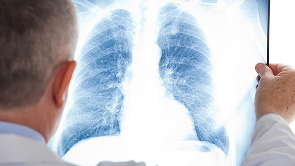 肺纤维化合并重度肺动脉高压能活多久