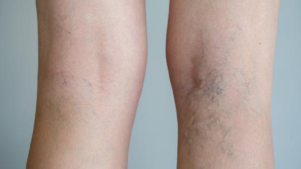 睡眠肌阵挛如何检查确诊