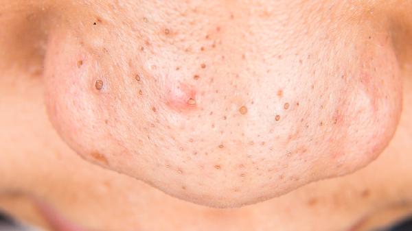 脸上有黑头怎么处理？六个实用方法轻松去掉黑头