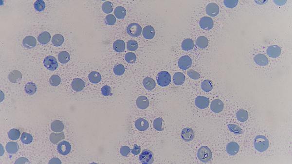 夜间咳嗽可能是癌症早期征兆