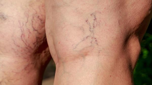 脸肿怎么快速消掉