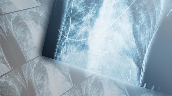 支气管肺炎常见症状和体征有哪些