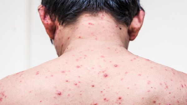 疥疮流脓引起疼痛能用布洛芬吗