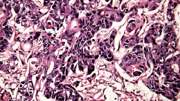 鼻病毒阳性可以做雾化吗