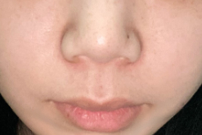 宝宝鼻子呼噜有痰怎么处理