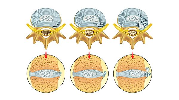 鼻病毒能通过咽拭子检测吗