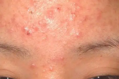 痘痘消了但留下痘坑痘印怎么处理