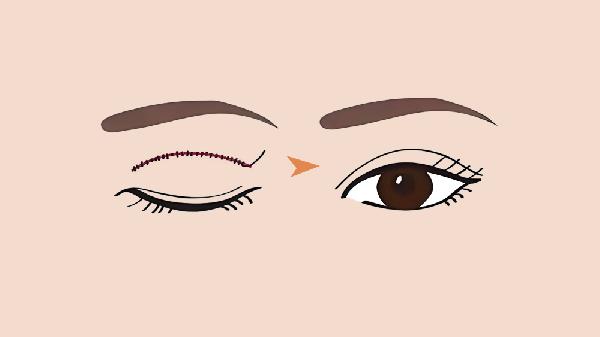 埋线双眼皮和全切哪种更自然好看