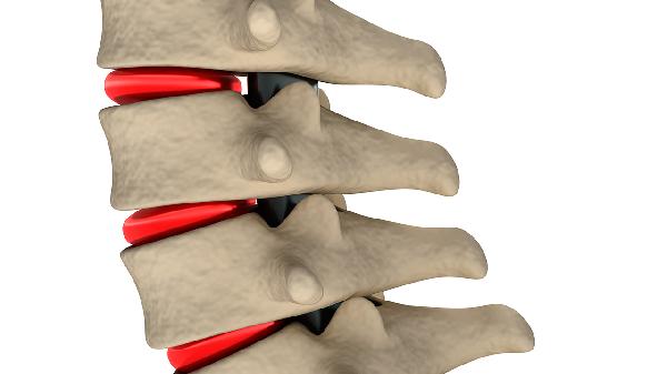 椎体骨质增生到底是什么病