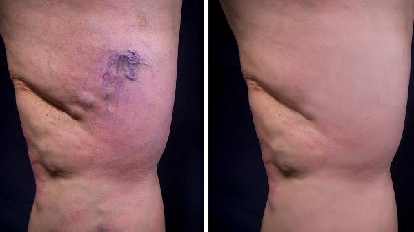 身体浮肿是怎么回事