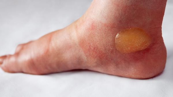 足底疼痛是怎么回事，怎么缓解和治疗