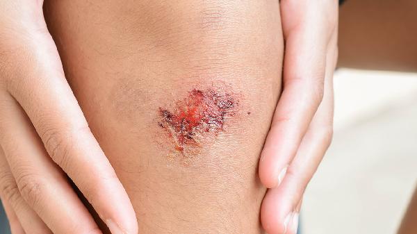 冻伤后为什么会起水泡