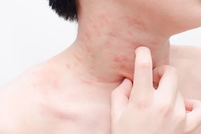 荨麻疹多久能好 一般需要几天恢复