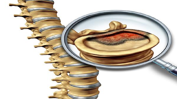 椎间盘突出手术后可能出现哪些后遗症