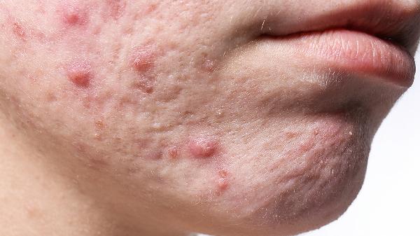 洗脸后怎么处理才能让皮肤更好