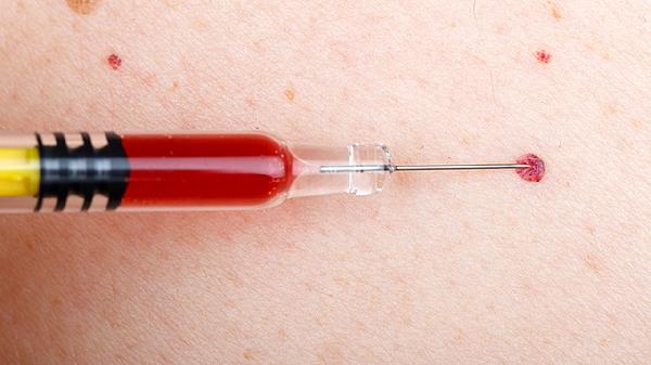 蛛网膜下腔出血是怎么引起的？常见原因有哪些