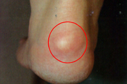 跟腱炎鼓包怎么消除最有效