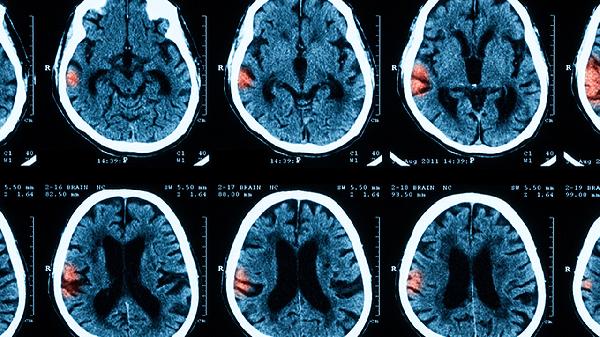 四个月大宝宝出现这些症状要警惕脑膜炎