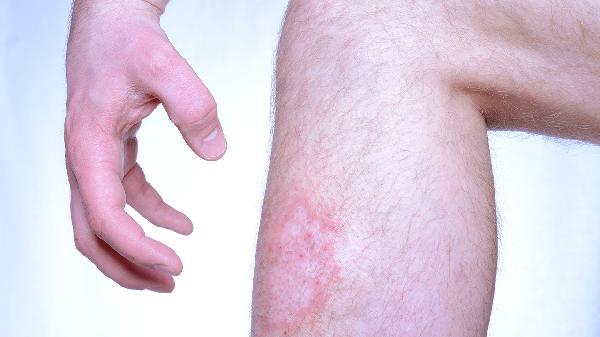 皮肤上长的疣到底是什么原因引起的