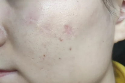 痘印怎么消除有效方法有哪些