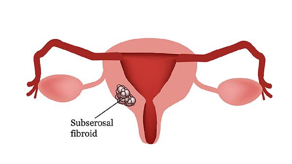 宫颈腺癌到底是什么病