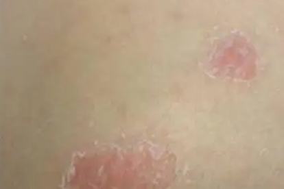 头皮银屑病怎么用药效果好