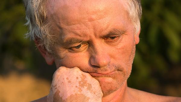 男性皮肤粗糙毛孔问题怎么解决